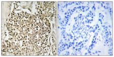 CEP350 / CAP350 Antibody - Immunohistochemistry analysis of paraffin-embedded human breast carcinoma, using CEP350 Antibody. The picture on the right is blocked with the synthesized peptide.