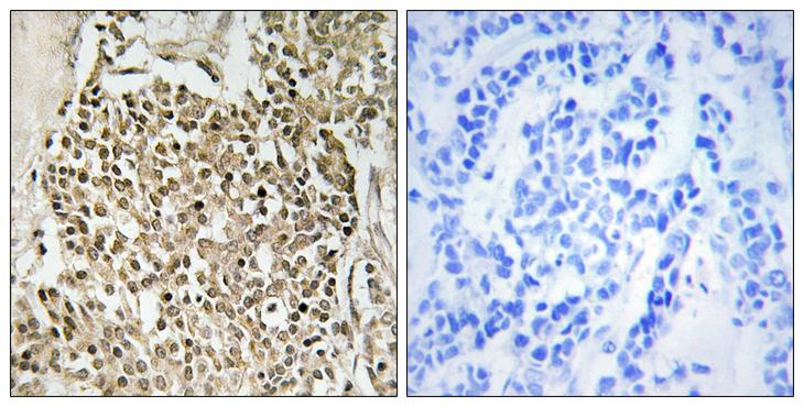 CEP350 / CAP350 Antibody - Peptide - + Immunohistochemistry analysis of paraffin-embedded human breast carcinoma tissue using CEP350 antibody.