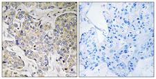 CEP41 / TSGA14 Antibody - Peptide - + Immunohistochemistry analysis of paraffin-embedded human breast carcinoma tissue using CEP41 antibody.