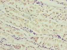 CEP44 / KIAA1712 Antibody - Immunohistochemistry of paraffin-embedded human gastric cancer at dilution of 1:100