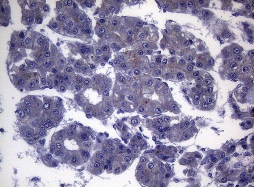 CEP55 Antibody - Immunohistochemical staining of paraffin-embedded Carcinoma of Human liver tissue using anti-CEP55 mouse monoclonal antibody. (Heat-induced epitope retrieval by 1mM EDTA in 10mM Tris buffer. (pH8.5) at 120°C for 3 min. (1:150)