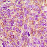 CEP55 Antibody - Immunohistochemical analysis of CEP55 staining in human breast cancer formalin fixed paraffin embedded tissue section. The section was pre-treated using heat mediated antigen retrieval with sodium citrate buffer (pH 6.0). The section was then incubated with the antibody at room temperature and detected using an HRP conjugated compact polymer system. DAB was used as the chromogen. The section was then counterstained with haematoxylin and mounted with DPX.