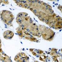 CEP57L1 Antibody - Immunohistochemical analysis of CEP57L1 staining in human gastric cancer formalin fixed paraffin embedded tissue section. The section was pre-treated using heat mediated antigen retrieval with sodium citrate buffer (pH 6.0). The section was then incubated with the antibody at room temperature and detected using an HRP conjugated compact polymer system. DAB was used as the chromogen. The section was then counterstained with hematoxylin and mounted with DPX.