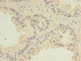 CEP63 Antibody - Immunohistochemistry of paraffin-embedded human prostate cancer using CEP63 Antibody at dilution of 1:100