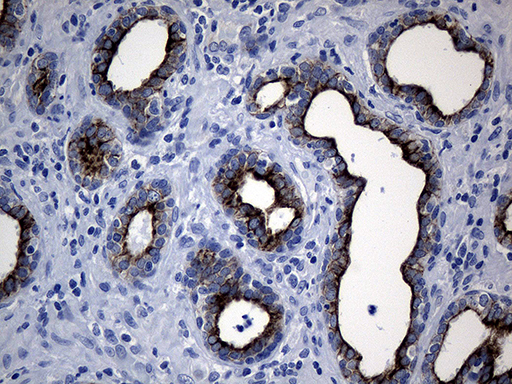 CEP63 Antibody - Immunohistochemical staining of paraffin-embedded Carcinoma of Human prostate tissue using anti-CEP63 mouse monoclonal antibody. (Heat-induced epitope retrieval by 1mM EDTA in 10mM Tris buffer. (pH8.5) at 120°C for 3 min. (1:500)