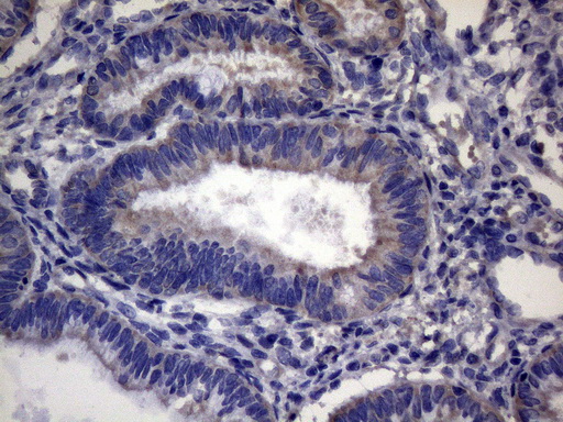 CEP63 Antibody - Immunohistochemical staining of paraffin-embedded Adenocarcinoma of Human endometrium tissue using anti-CEP63 mouse monoclonal antibody. (Heat-induced epitope retrieval by 1mM EDTA in 10mM Tris buffer. (pH8.5) at 120°C for 3 min. (1:150)