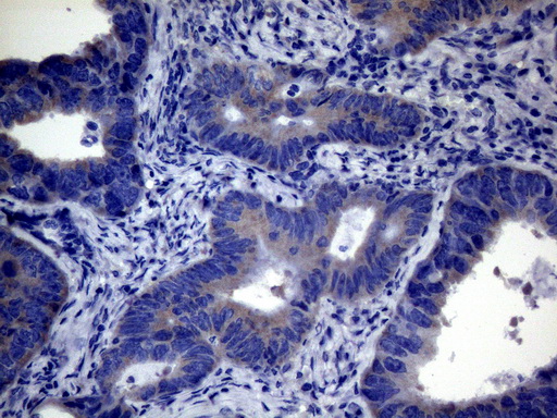 CEP63 Antibody - Immunohistochemical staining of paraffin-embedded Adenocarcinoma of Human colon tissue using anti-CEP63 mouse monoclonal antibody. (Heat-induced epitope retrieval by 1mM EDTA in 10mM Tris buffer. (pH8.5) at 120°C for 3 min. (1:150)
