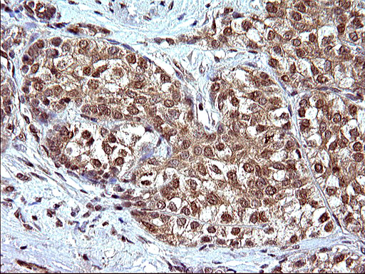 CEP68 Antibody - IHC of paraffin-embedded Carcinoma of Human liver tissue using anti-CEP68 mouse monoclonal antibody. (Heat-induced epitope retrieval by 10mM citric buffer, pH6.0, 120°C for 3min).