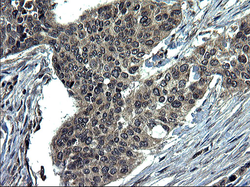 CEP68 Antibody - IHC of paraffin-embedded Carcinoma of Human bladder tissue using anti-CEP68 mouse monoclonal antibody. (Heat-induced epitope retrieval by 1 mM EDTA in 10mM Tris, pH8.5, 120°C for 3min).