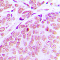 CEP70 Antibody - Immunohistochemical analysis of CEP70 staining in human breast cancer formalin fixed paraffin embedded tissue section. The section was pre-treated using heat mediated antigen retrieval with sodium citrate buffer (pH 6.0). The section was then incubated with the antibody at room temperature and detected using an HRP conjugated compact polymer system. DAB was used as the chromogen. The section was then counterstained with hematoxylin and mounted with DPX.