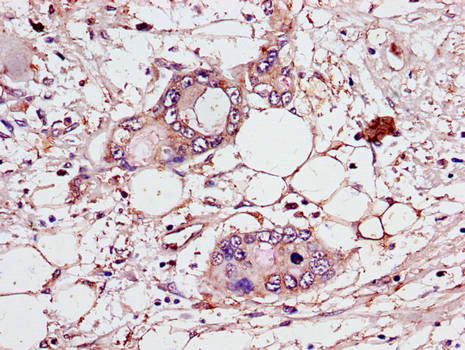CEP70 Antibody - Immunohistochemistry of paraffin-embedded human pancreatic cancer using CEP70 Antibody at dilution of 1:100