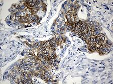 CEP72 Antibody - Immunohistochemical staining of paraffin-embedded Adenocarcinoma of Human colon tissue using anti-CEP72 mouse monoclonal antibody. (Heat-induced epitope retrieval by 1mM EDTA in 10mM Tris buffer. (pH8.5) at 120°C for 3 min. (1:500)