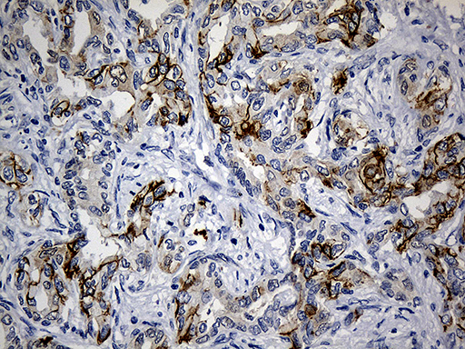 CEP72 Antibody - Immunohistochemical staining of paraffin-embedded Carcinoma of Human liver tissue using anti-CEP72 mouse monoclonal antibody. (Heat-induced epitope retrieval by 1mM EDTA in 10mM Tris buffer. (pH8.5) at 120°C for 3 min. (1:500)