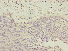 CEP72 Antibody - Immunohistochemistry of paraffin-embedded human cervical cancer at dilution of 1:100