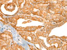 CEP72 Antibody - Immunohistochemistry of paraffin-embedded Human thyroid cancer tissue  using CEP72 Polyclonal Antibody at dilution of 1:40(×200)