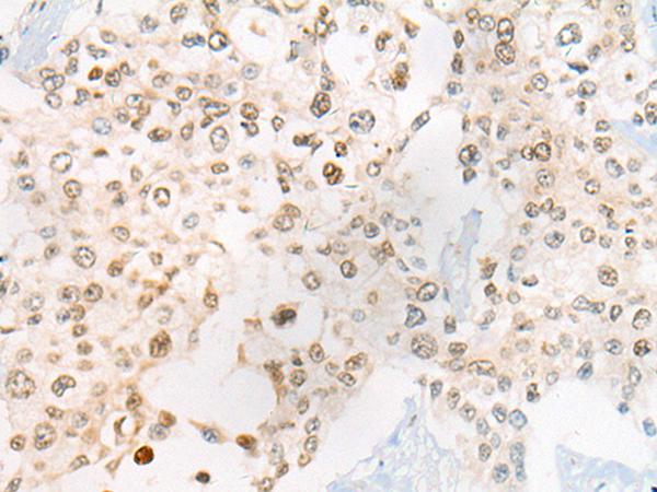 CEP72 Antibody - Immunohistochemistry of paraffin-embedded Human prost ate cancer tissue  using CEP72 Polyclonal Antibody at dilution of 1:40(×200)
