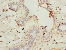CEP76 Antibody - Immunohistochemistry of paraffin-embedded human breast cancer using antibody at dilution of 1:100.