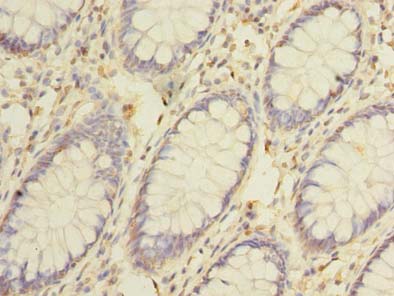 CEP76 Antibody - Immunohistochemistry of paraffin-embedded human colon cancer using antibody at dilution of 1:100.