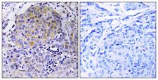 CEP78 / IP63 Antibody - Immunohistochemistry analysis of paraffin-embedded human breast carcinoma tissue, using CEP78 Antibody. The picture on the right is blocked with the synthesized peptide.