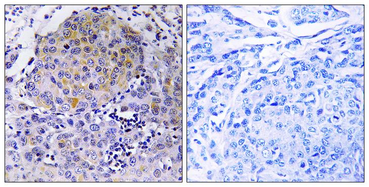 CEP78 / IP63 Antibody - Peptide - + Immunohistochemistry analysis of paraffin-embedded human breast carcinoma tissue, using CEP78 antibody.