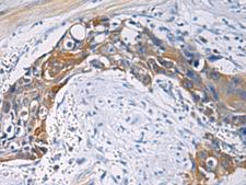 CEP89 Antibody - Immunohistochemistry of paraffin-embedded Human esophagus cancer tissue  using CEP89 Polyclonal Antibody at dilution of 1:100(×200)
