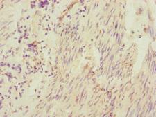 CEP95 / CCDC45 Antibody - Immunohistochemistry of paraffin-embedded human bladder cancer at dilution of 1:100