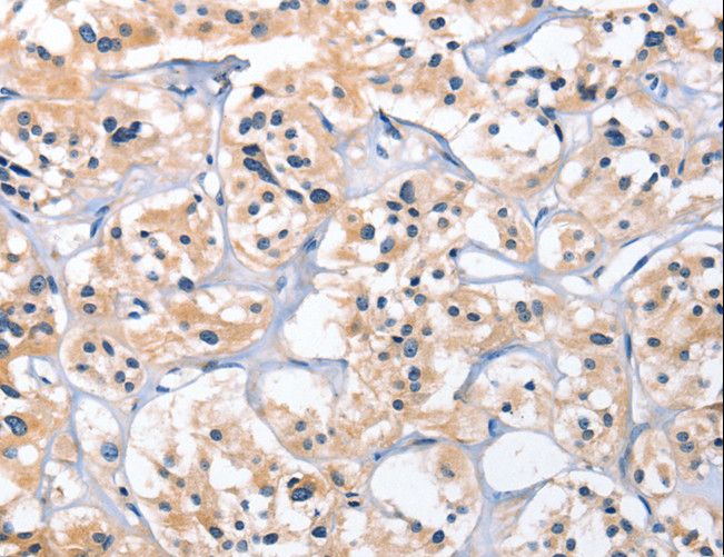 CEP97 Antibody - Immunohistochemistry of paraffin-embedded Human thyroid cancer using CEP97 Polyclonal Antibody at dilution of 1:25.