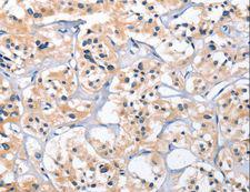 CEP97 Antibody - Immunohistochemistry of paraffin-embedded Human thyroid cancer using CEP97 Polyclonal Antibody at dilution of 1:25.