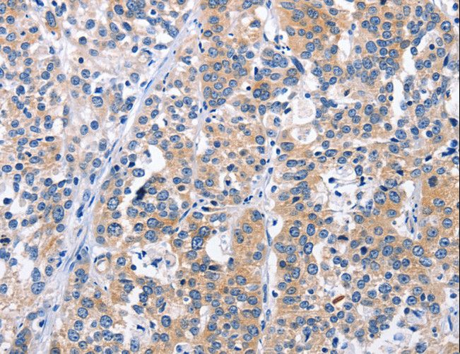 CEP97 Antibody - Immunohistochemistry of paraffin-embedded Human esophagus cancer using CEP97 Polyclonal Antibody at dilution of 1:25.