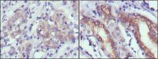 CER1 Antibody - IHC of paraffin-embedded human gastric cancer (left) and normal gastric tissues (right) using CER1 mouse monoclonal antibody with DAB staining.