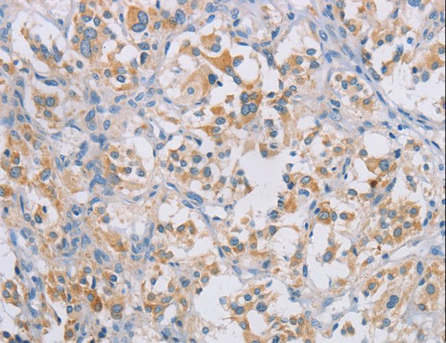 CERKL Antibody - Immunohistochemistry of paraffin-embedded Human gastric cancer using CERKL Polyclonal Antibody at dilution of 1:50.