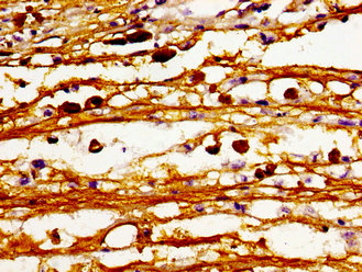 CerS6 / LASS6 Antibody - Immunohistochemistry image of paraffin-embedded human melanoma cancer at a dilution of 1:100