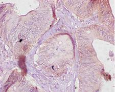 Ces1c / Carboxylesterase 1C Antibody - Immunohistochemistry of paraffin-embedded human colon cancer using Ces1c Antibody at dilution of 1:10