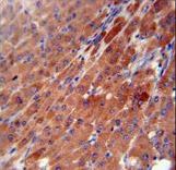 CES2 / Esterase Antibody - CES2 antibody immunohistochemistry of formalin-fixed and paraffin-embedded human hepatocarcinoma followed by peroxidase-conjugated secondary antibody and DAB staining.