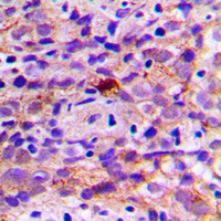 CES2 / Esterase Antibody - Immunohistochemical analysis of CES2 staining in human breast cancer formalin fixed paraffin embedded tissue section. The section was pre-treated using heat mediated antigen retrieval with sodium citrate buffer (pH 6.0). The section was then incubated with the antibody at room temperature and detected using an HRP conjugated compact polymer system. DAB was used as the chromogen. The section was then counterstained with hematoxylin and mounted with DPX.