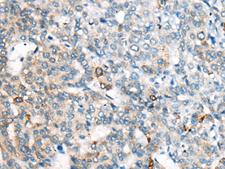 CES2 / Esterase Antibody - Immunohistochemistry of paraffin-embedded Human liver cancer tissue  using CES2 Polyclonal Antibody at dilution of 1:55(×200)