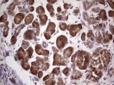 CETN1 Antibody - Immunohistochemical staining of paraffin-embedded Carcinoma of Human pancreas tissue using anti-CETN1 mouse monoclonal antibody. (Heat-induced epitope retrieval by 1 mM EDTA in 10mM Tris, pH8.5, 120C for 3min,