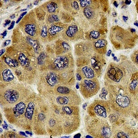 CETN1 Antibody - Immunohistochemical analysis of Centrin-1 staining in human liver cancer formalin fixed paraffin embedded tissue section. The section was pre-treated using heat mediated antigen retrieval with sodium citrate buffer (pH 6.0). The section was then incubated with the antibody at room temperature and detected using an HRP conjugated compact polymer system. DAB was used as the chromogen. The section was then counterstained with hematoxylin and mounted with DPX.