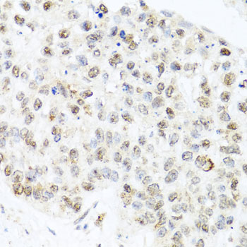 CETN3 Antibody - Immunohistochemistry of paraffin-embedded human lung cancer tissue.