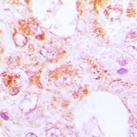 CETN3 Antibody - Immunohistochemical analysis of Centrin-3 staining in human lung cancer formalin fixed paraffin embedded tissue section. The section was pre-treated using heat mediated antigen retrieval with sodium citrate buffer (pH 6.0). The section was then incubated with the antibody at room temperature and detected using an HRP conjugated compact polymer system. DAB was used as the chromogen. The section was then counterstained with hematoxylin and mounted with DPX.