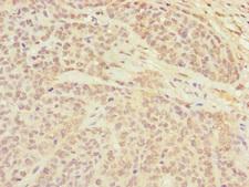 CETN3 Antibody - Immunohistochemistry of paraffin-embedded human ovarian cancer at dilution of 1:100