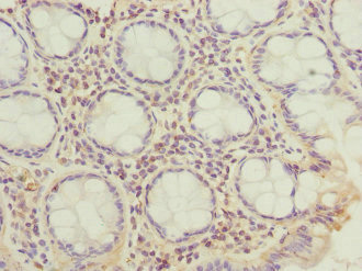 CFAP20 / GTL3 Antibody - Immunohistochemistry of paraffin-embedded human colon cancer at dilution 1:100