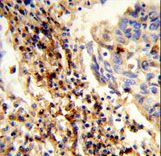 CFAP47 Antibody - Formalin-fixed and paraffin-embedded human lung carcinoma reacted with CXorf22 Antibody , which was peroxidase-conjugated to the secondary antibody, followed by DAB staining. This data demonstrates the use of this antibody for immunohistochemistry; clinical relevance has not been evaluated.