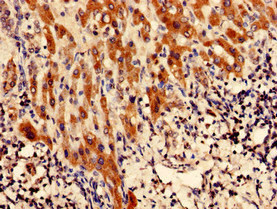 CFAP61 / C20orf26 Antibody - Immunohistochemistry analysis of human liver cancer using CFAP61 Antibody at dilution of 1:100