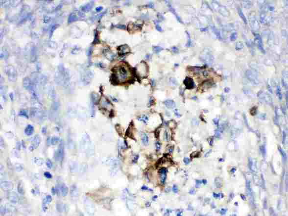 CFB / Complement Factor B Antibody - Factor B was detected in paraffin-embedded sections of human lung cancer tissues using rabbit anti- Factor B Antigen Affinity purified polyclonal antibody