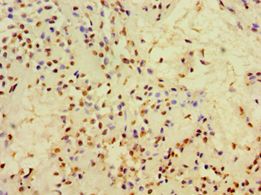 CFD / Factor D / Adipsin Antibody - Immunohistochemistry of paraffin-embedded human breast cancer using antibody at 1:100 dilution.