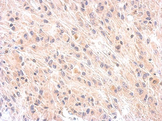 CFH / Complement Factor H Antibody - IHC of paraffin-embedded U373 xenograft using Factor H antibody at 1:200 dilution.