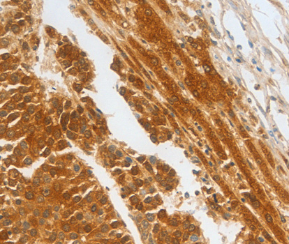 CFHR1 Antibody - Immunohistochemistry of paraffin-embedded human liver cancer tissue.