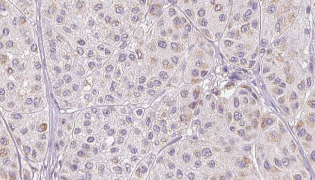 CFHR1 Antibody - 1:100 staining human Melanoma tissue by IHC-P. The sample was formaldehyde fixed and a heat mediated antigen retrieval step in citrate buffer was performed. The sample was then blocked and incubated with the antibody for 1.5 hours at 22°C. An HRP conjugated goat anti-rabbit antibody was used as the secondary.