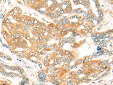 CFHR2 Antibody - Immunohistochemistry of paraffin-embedded Human liver cancer tissue  using CFHR2 Polyclonal Antibody at dilution of 1:35(×200)